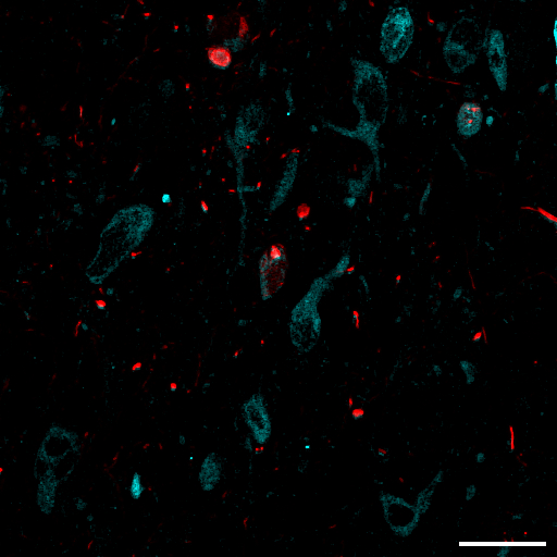 Image of serotonin neurons and tau in an alzheimer's disease human case